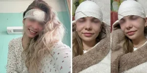 Из-за обычного прыщика россиянке разрезали лоб и положили в больницу.webp