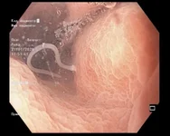 4-сантиметровые черви образовались в желудке пенсионерки из-за съеденной рыбы.webp